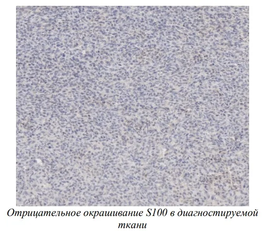 Саркома мягких тканей у собак - гистологическое исследование